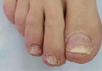 Mycosis of the nails caused problems