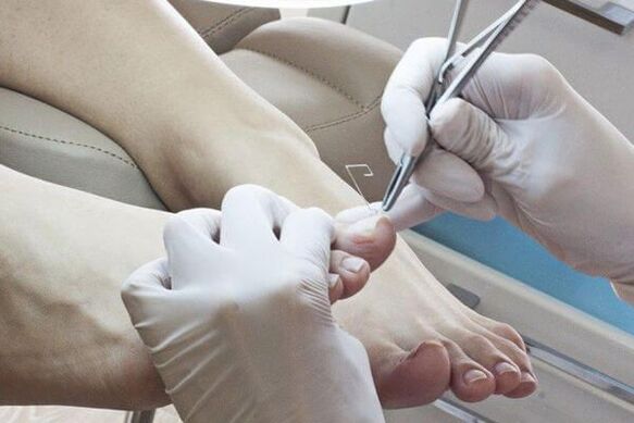 treatment of nail fungus with a doctor