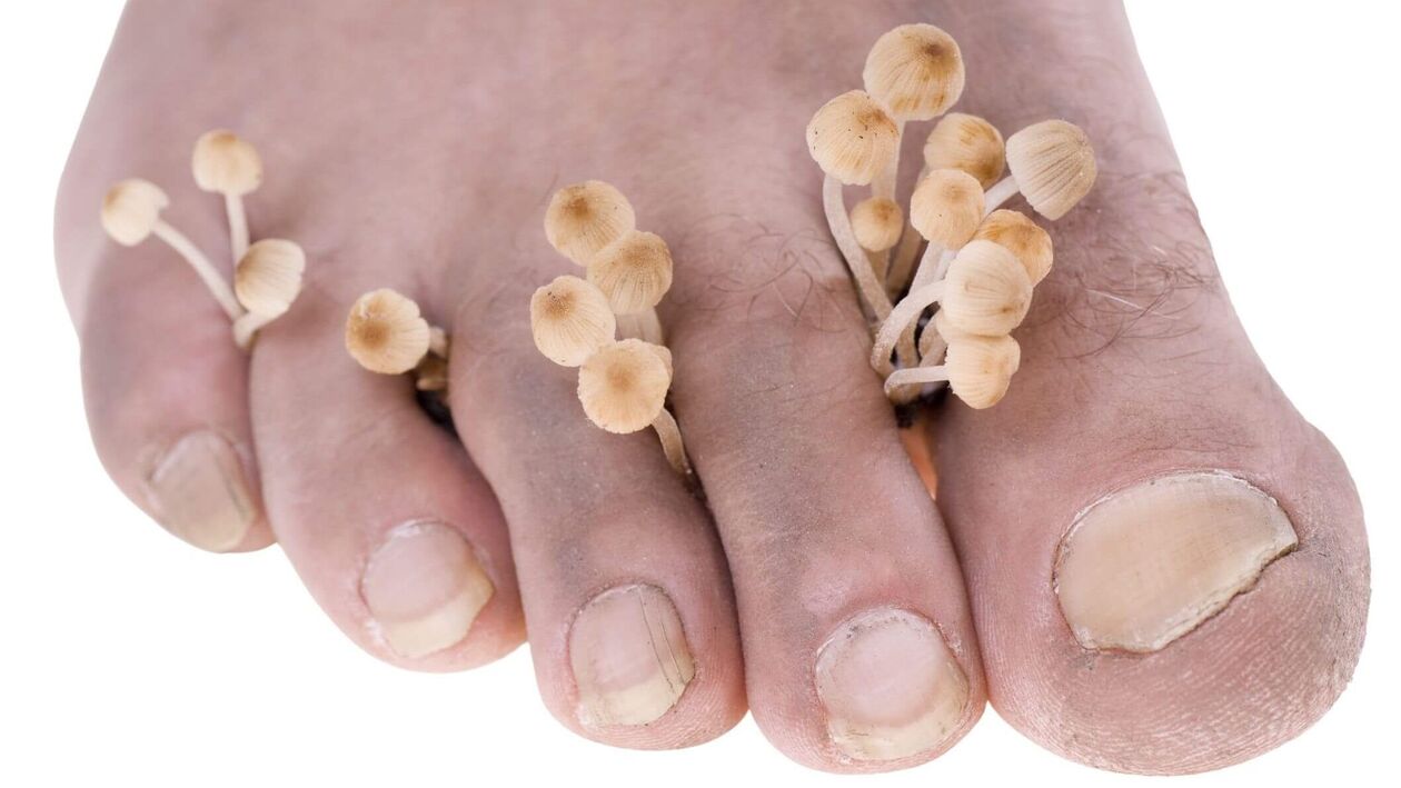 fungal infection of the feet of people