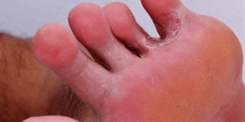 Fungi on your feet