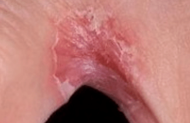 Fungus on the fingers between your fingers