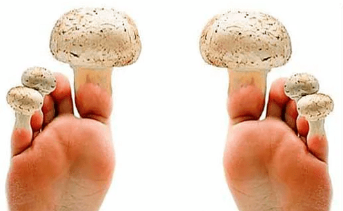 nail fungus