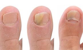 Phases of fungus development on the thumb leg