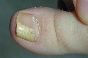 Reasons Appearance Fungi on the thumb leg