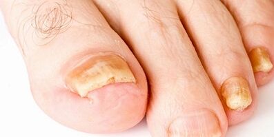How and how to cure nail fungus