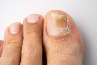 Micosa caused by yeast microorganisms