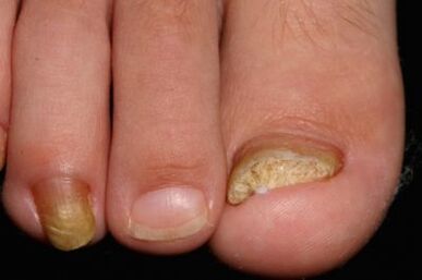 Micosis nails on their feet