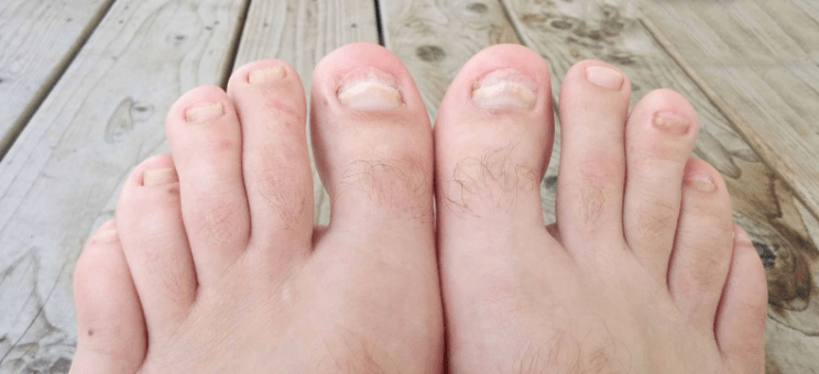 Fungus nail