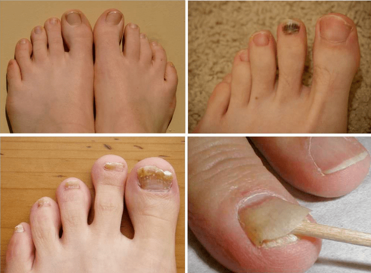 Signs Fungus Nail
