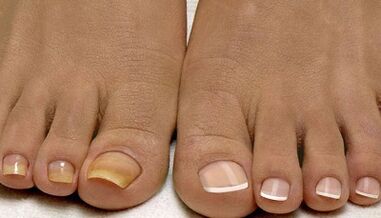 Causes appear to be fungus on nails