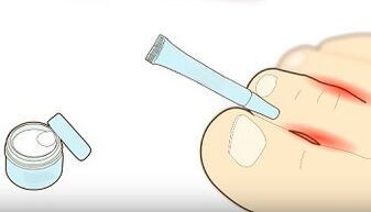How to treat a fungal on toes
