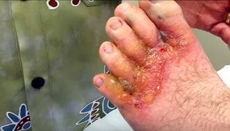 Symptoms of the fungus on the toes