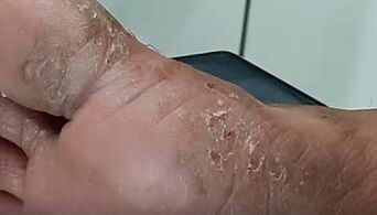 Types and forms of fungus on toes