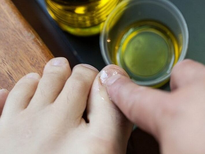Applying medicinal oil to nails affected by fungus