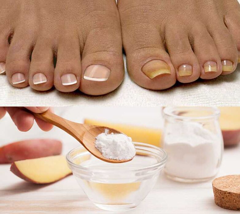 Soda for the treatment of nail fungus