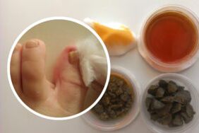 Treatment of toenail fungus with folk remedies