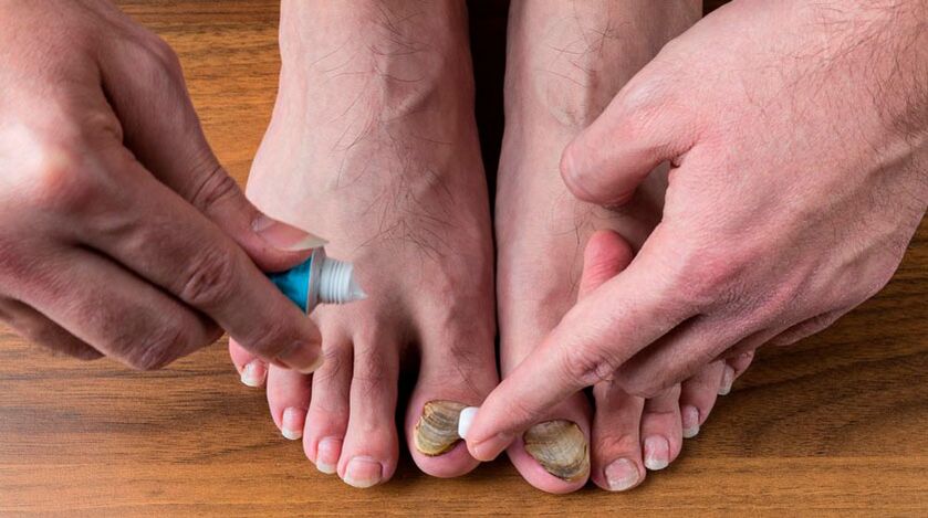 Applying an antifungal cream to the toenails to treat onychomycosis